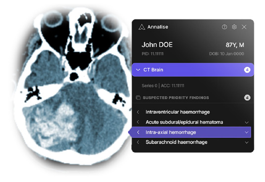 Annalise Enterprise CTB Triage Trauma interface