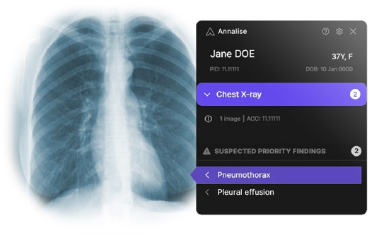 Annalise Enterprise CXR Triage interface