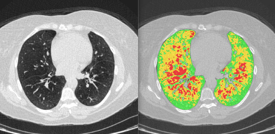 Lung Density Analysis-Functional interface